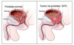 Quando a próstata está anormal, ela diminui o fluxo da uretra.